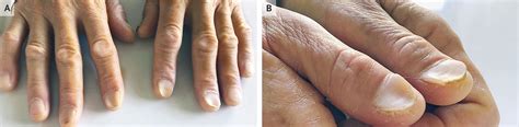 koilonychia anemia.
